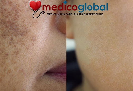 THE MOST EFFECTIVE WAY TO TREAT MELASMA