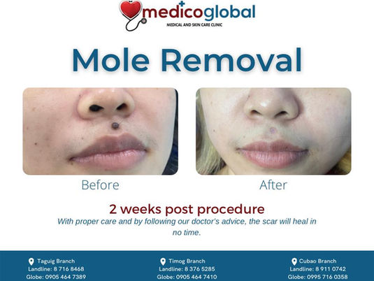 Need a mole removal?