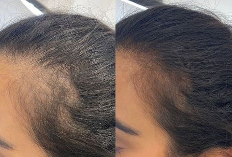 tricopigmentation-blush-france-brdeaux