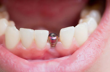 o-que-é-um-implante-dentário-1024x671.