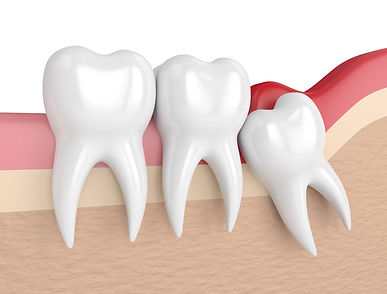 282485-duvidas-sobre-o-dente-do-siso-sol