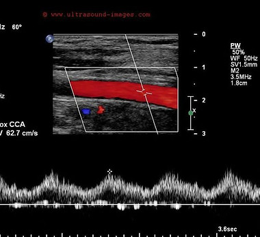 A Gallery of High-Resolution, Ultrasound, Color Doppler & 3D Images - Vascular.jpg