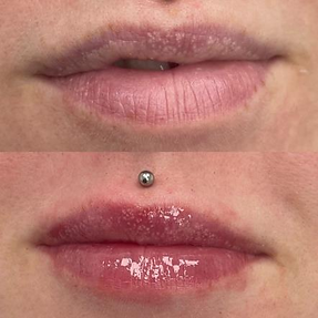 Lip Filler, Gift Aesthetics
