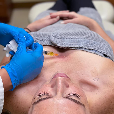 Platelet Rich Fibrin Skin Rejuvenation in Ogden, UT