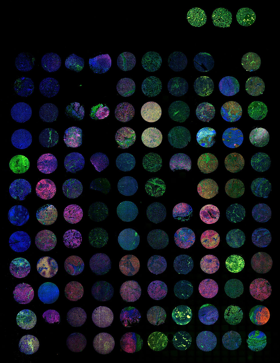 TMA_Melanoma-Biobank_Levesque-Lab_Switzerland_low.jpg