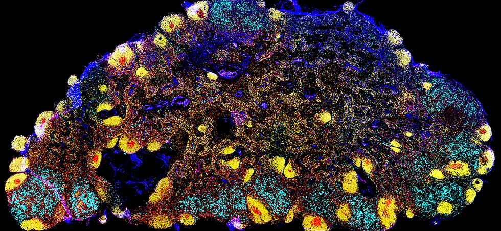Multiplex immunohistochemistry image of a melanoma lymph node metastasis. Melanoma cells (S100⁺/MelanA⁺) are shown in light blue, follicular dendritic cells (CD21⁺) in red, and B cells (CD79A⁺) in yellow.