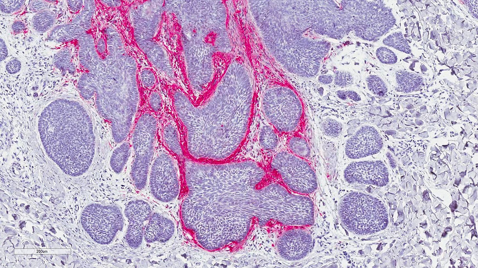 Basal cell carcinoma microenvironment stained with an antibody for collagen type X.