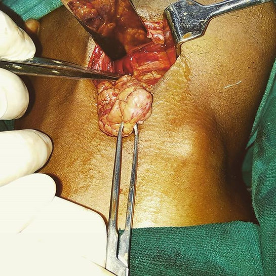 Submandibular gland excision.jpg