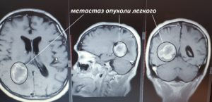 Метастазы в головной мозг.