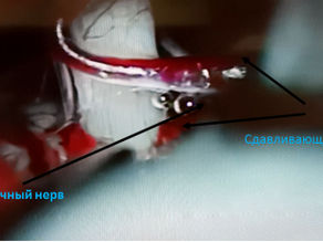 Невралгия тройничного нерва.