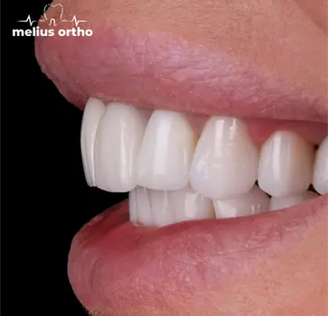 Бічний вид на посмішку з вирівняними зубами, melius ortho