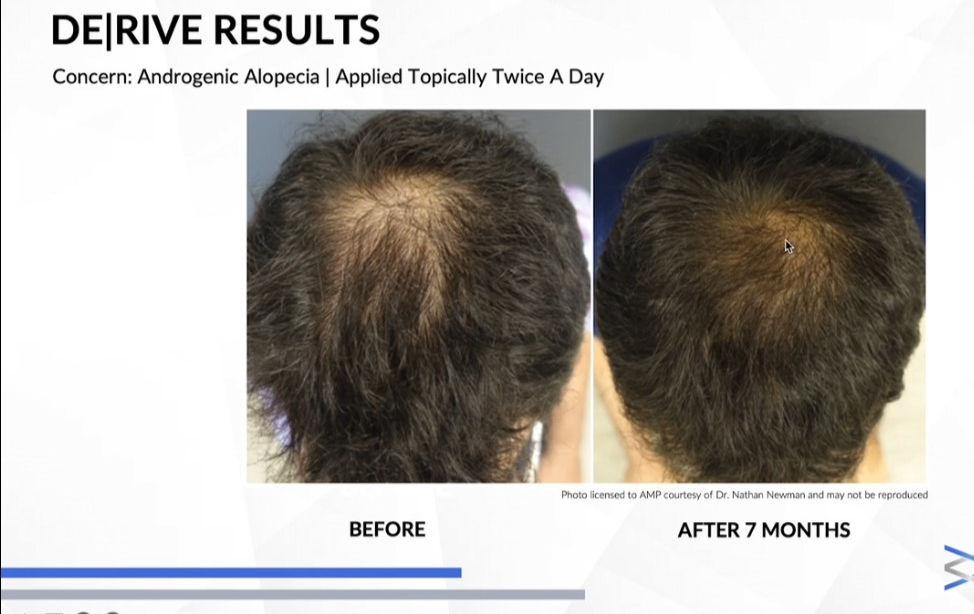 Thumbnail: 6 Part Trusted Hair Growth System & Redlight