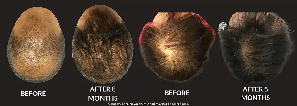 Thumbnail: 6 Part Trusted Hair Growth System & Redlight