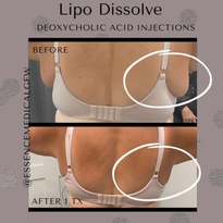 Essence Medical - Lipo Dissolve
