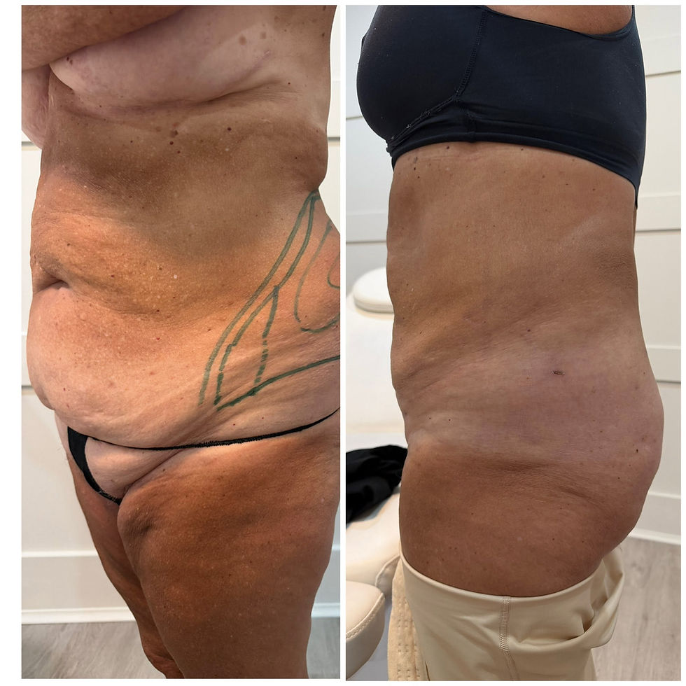Tumescent Liposuction 11