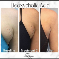 Essence Medical - Deoxycholic Acid