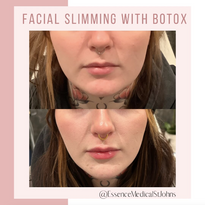 Essence Medical - Botox