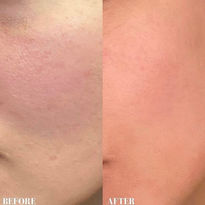 Essence Medical - Rosacea Treatment