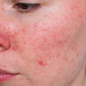 Understanding Rosacea + Facials