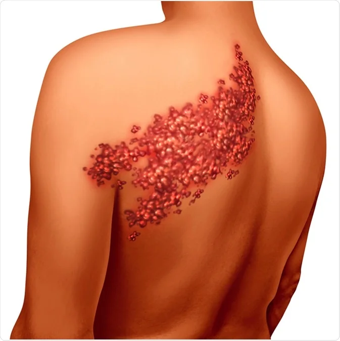 Shingles.webp