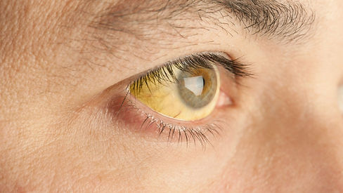 Jaundice pic.jpeg