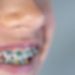 Braces in Whittier