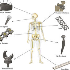 3D PRINTING IN ORTHOPEDIC IMPLANTS