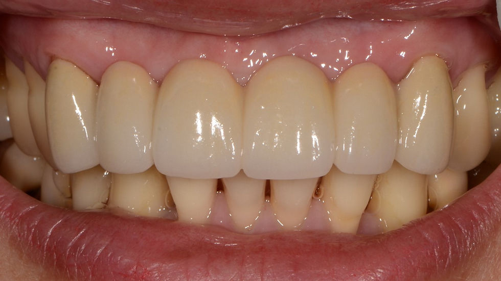 Dental bridge replaces front missing teeth without surgery | Oasis Dental Milton