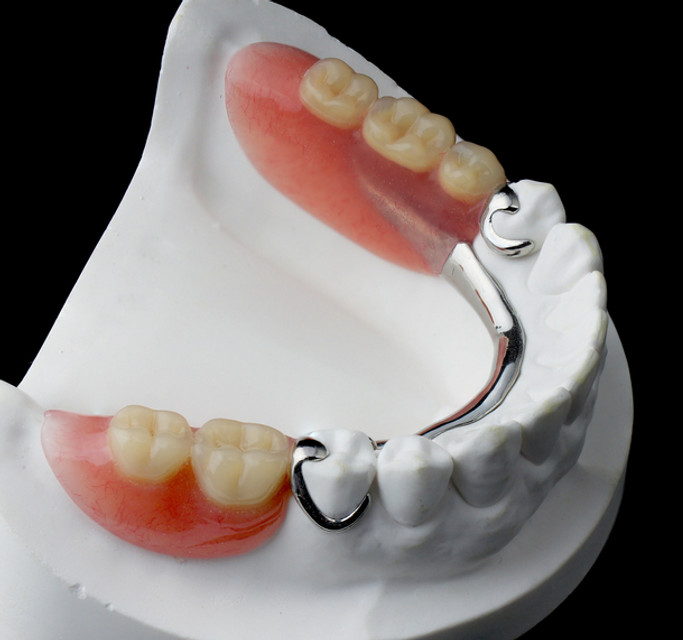 Partial denture snap on denture alternative to dental implants in Milton, Oakville, Burlington, Mississauga, Toronto, Campbellville, Clarkson