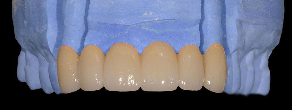 What a dental bridge looks like | Oasis Dental Milton