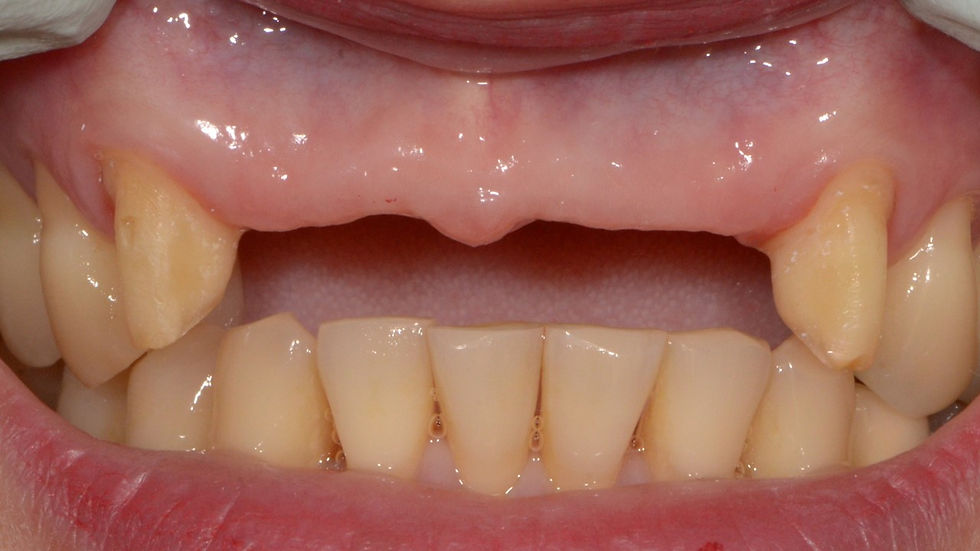 Missing front teeth replaced with a dental bridge | Oasis Dental Milton