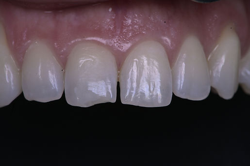 Dental bonding tooth filling for chipped front tooth in Milton, Oakville, Burlington, Mississauga, Toronto, Brampton, Hamilton, Waterdown, Brantford