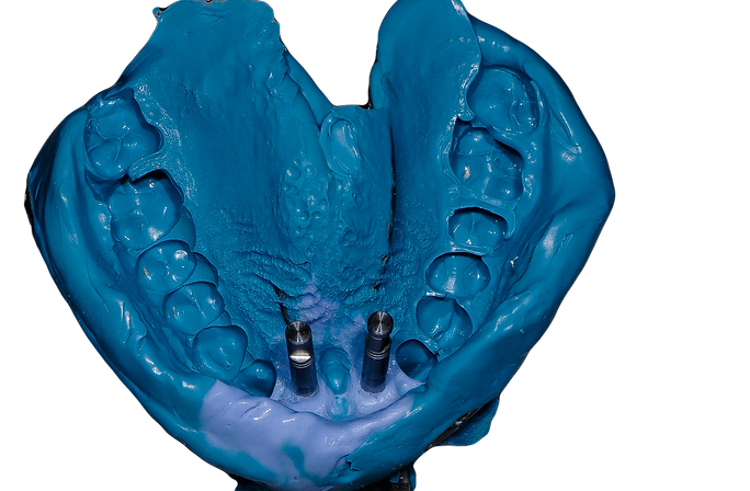 Dental molds for Dental implants, All on 4, all on four, all on 6, Teeth in a day in Milton, Burlington, Oakville