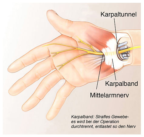 Karpaltunnelsyndrom 1.jpeg