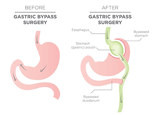 Gastric_Bypass_Surgery_for_web.webp