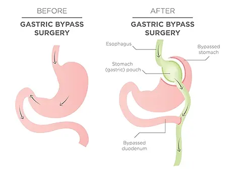 Gastric_Bypass_Surgery_for_web.webp