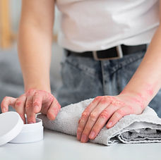 manos-del-paciente-que-sufre-de-psoriasis.jpg