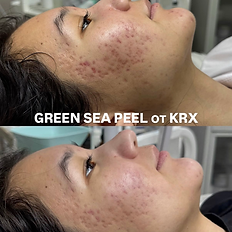 Before and after Green Sea Peel results showing improved acne scars and skin texture, Wellington FL