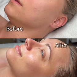 before after of Custom Skin Corrective Peel in wellington fl