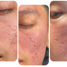 Before and after photos of hyperpigmentation treated with Green Sea Peel, Wellington FL
