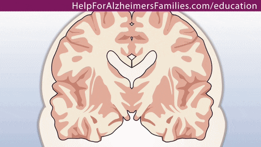 Fisioterapia para Alzheimer
