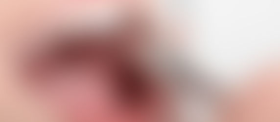 Are You Experiencing Wisdom Teeth Pain? Learn When To Consider Removal