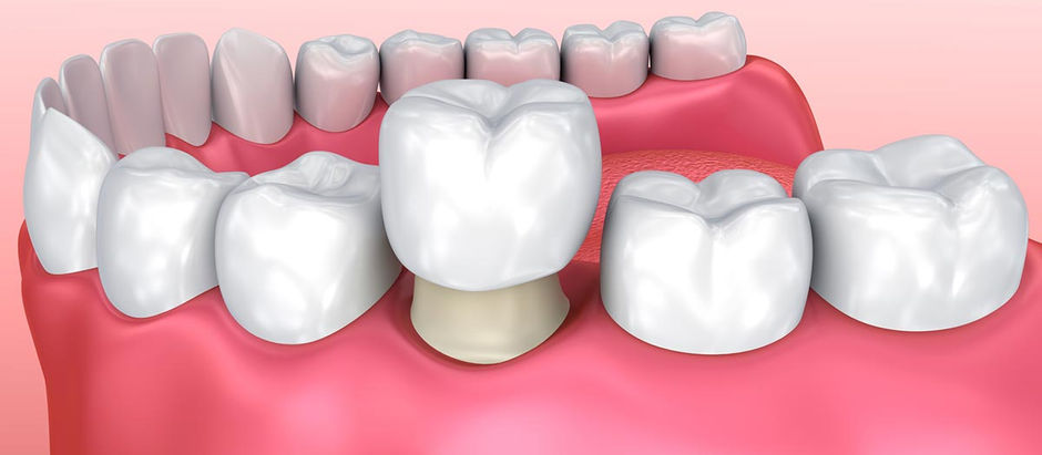 How To Take Care For Metal Braces After Orthodontic Treatment In Houston?