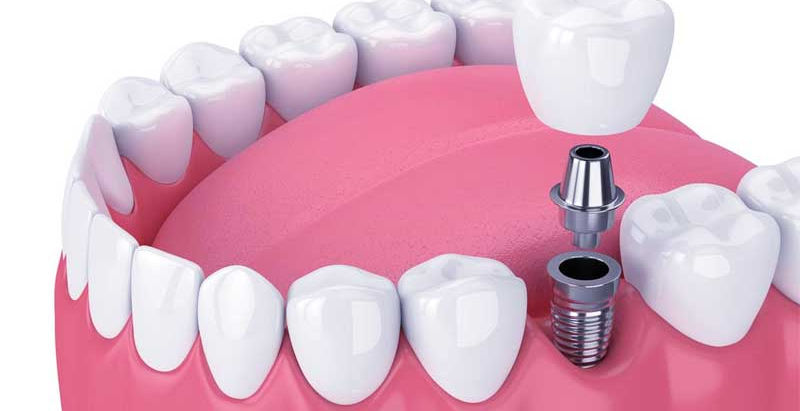 How much do Dental Implants Cost on Average?