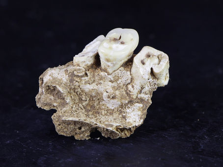 The Link between Ancient DNA and Multiple Sclerosis in Northern Europeans