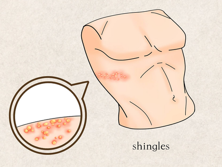 Acupuncture for Shingles: What the Evidence ShowsPain Relief and Symptom Management