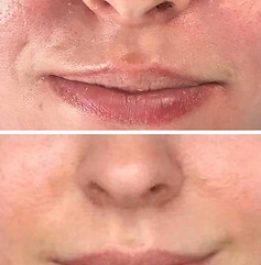 Diamond peeling, Dianalund, Vestsjælland. Skønhed, simple beauty by pautsch, Dianalund, skønhed, ansigtsbehandling, uren hud, akne, rynker, rynkebehandling, Beauty shop, skønhedssalon, Karsprængninger, Behandling, Blodsprængninger, laser, frugtsyre peeling, frugtsyre, fugtighedsmaske, ansigtsmaske, ansigtsbehandling, luksus, velvære