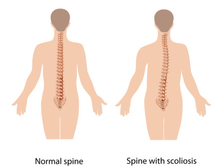 What is Scoliosis?
