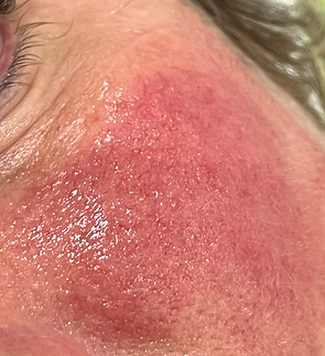 Thread Veins immediately after.HEIC