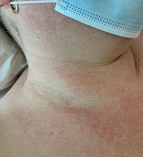 skin tags after.jpg